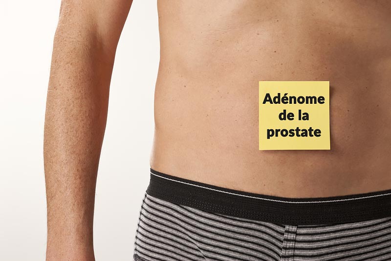 adenome-prostate-slip